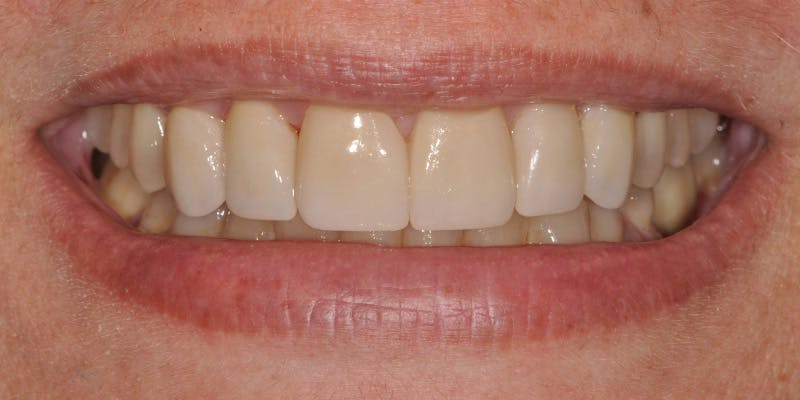 Patient Results Before & After Gallery - Patient 415892 - Image 2