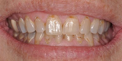 Patient Results Before & After Gallery - Patient 262489 - Image 1