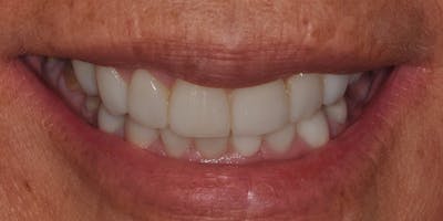 Patient Results Before & After Gallery - Patient 262489 - Image 2