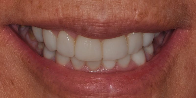 Patient Results Before & After Gallery - Patient 262489 - Image 2