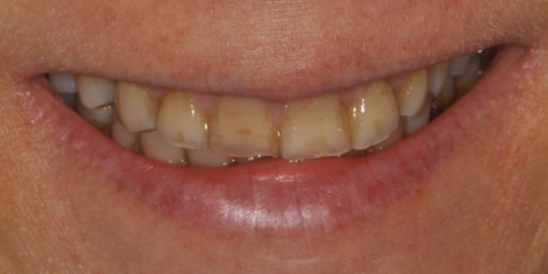 Patient Results Before & After Gallery - Patient 297578 - Image 1