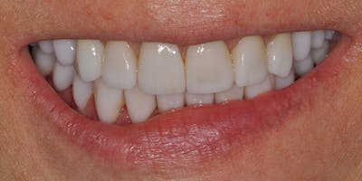 Patient Results Before & After Gallery - Patient 297578 - Image 2