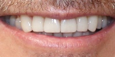 Patient Results Before & After Gallery - Patient 882685 - Image 2