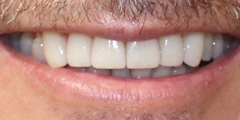 Patient Results Before & After Gallery - Patient 882685 - Image 2