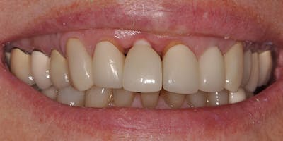 Patient Results Before & After Gallery - Patient 415160 - Image 1