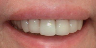 Patient Results Before & After Gallery - Patient 415160 - Image 2