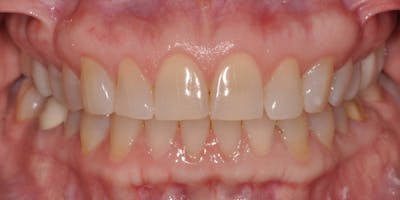 Patient Results Before & After Gallery - Patient 238854 - Image 1