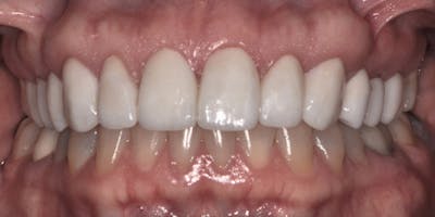 Patient Results Before & After Gallery - Patient 238854 - Image 2