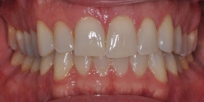 Patient Results Before & After Gallery - Patient 990928 - Image 1