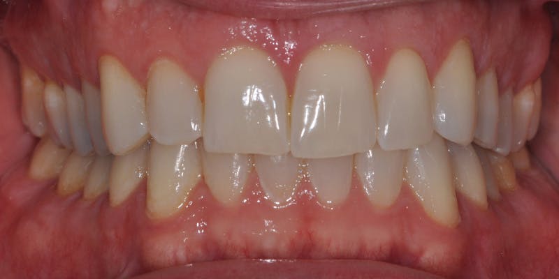 Patient Results Before & After Gallery - Patient 990928 - Image 1