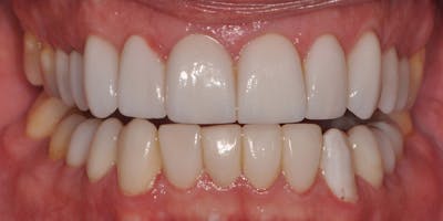Patient Results Before & After Gallery - Patient 990928 - Image 2