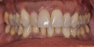 Patient Results Before & After Gallery - Patient 187015 - Image 1
