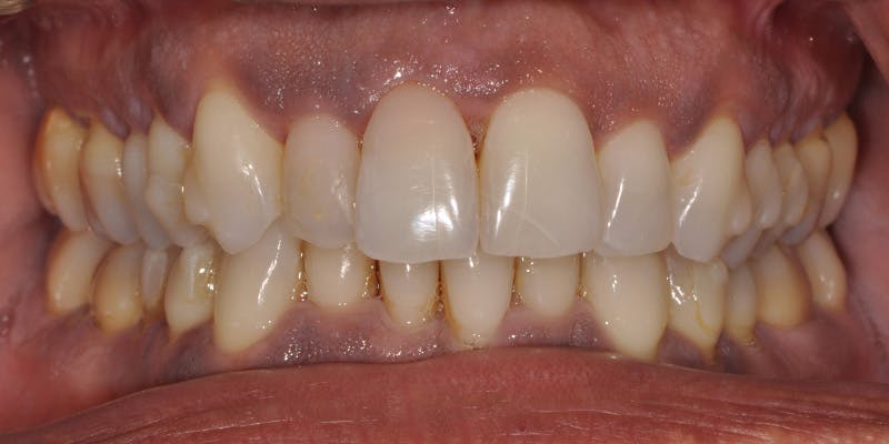 Patient Results Before & After Gallery - Patient 187015 - Image 1