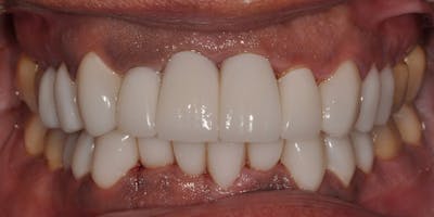 Patient Results Before & After Gallery - Patient 187015 - Image 2