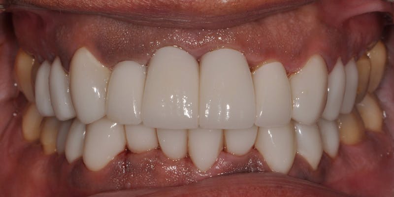 Patient Results Before & After Gallery - Patient 187015 - Image 2