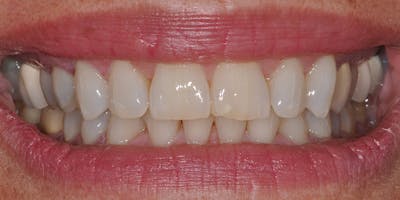 Patient Results Before & After Gallery - Patient 270736 - Image 1
