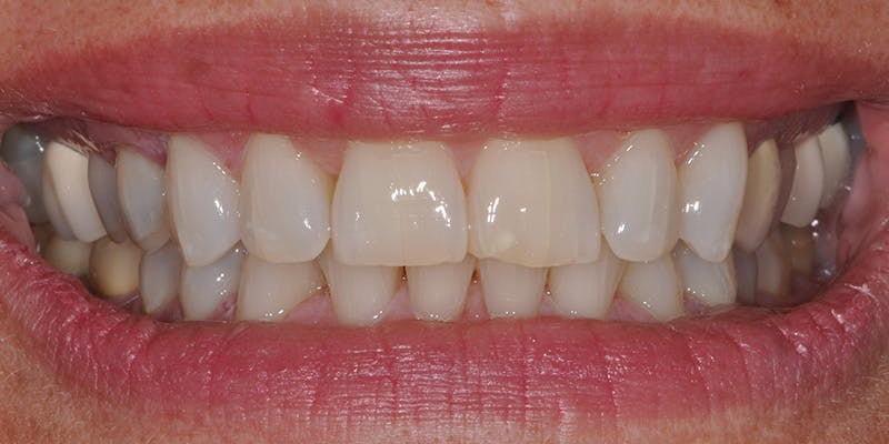Patient Results Before & After Gallery - Patient 270736 - Image 1