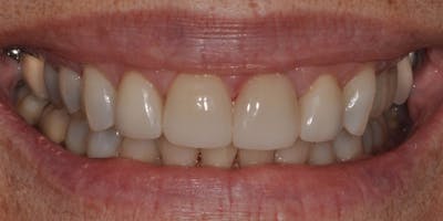 Patient Results Before & After Gallery - Patient 270736 - Image 2