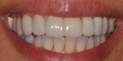 Patient Results Before & After Gallery - Patient 511530 - Image 2