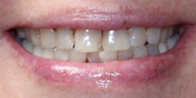 Patient Results Before & After Gallery - Patient 332194 - Image 1