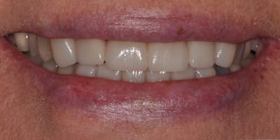Patient Results Before & After Gallery - Patient 332194 - Image 2