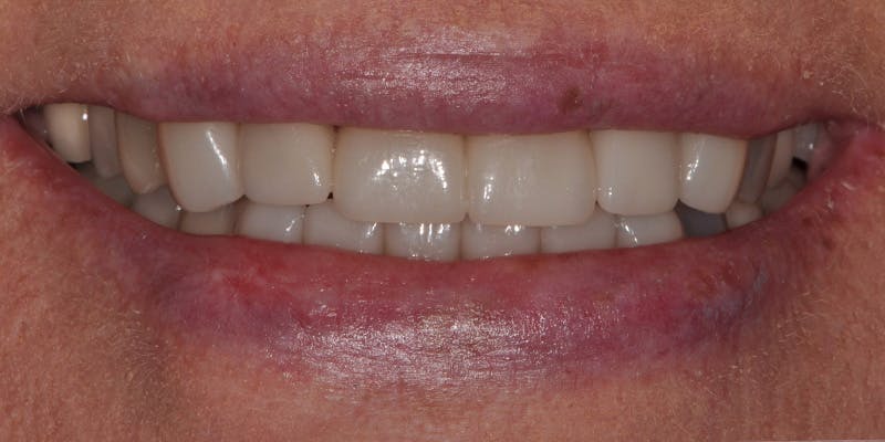 Patient Results Before & After Gallery - Patient 332194 - Image 2