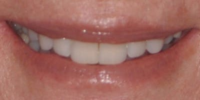 Patient Results Before & After Gallery - Patient 363568 - Image 1