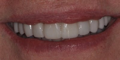Patient Results Before & After Gallery - Patient 363568 - Image 2