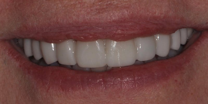 Patient Results Before & After Gallery - Patient 363568 - Image 2