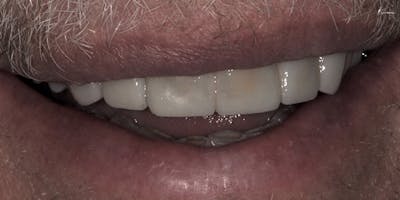 Patient Results Before & After Gallery - Patient 156865 - Image 1