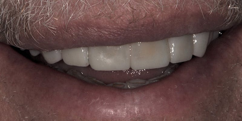 Patient Results Before & After Gallery - Patient 156865 - Image 1