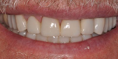 Patient Results Before & After Gallery - Patient 156865 - Image 2