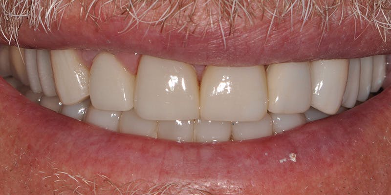 Patient Results Before & After Gallery - Patient 156865 - Image 2