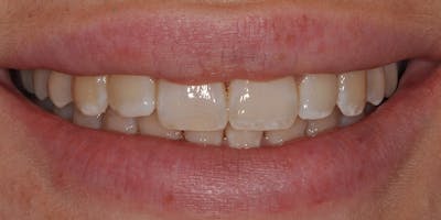 Patient Results Before & After Gallery - Patient 394300 - Image 1