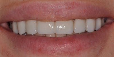 Patient Results Before & After Gallery - Patient 394300 - Image 2