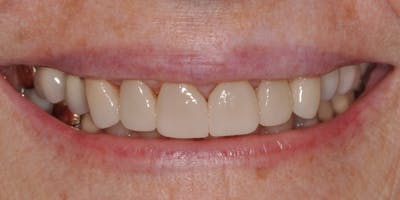 Patient Results Before & After Gallery - Patient 279585 - Image 2