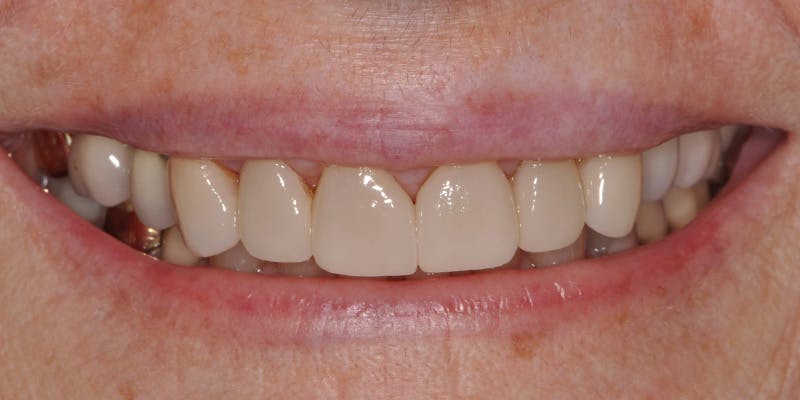 Patient Results Before & After Gallery - Patient 279585 - Image 2