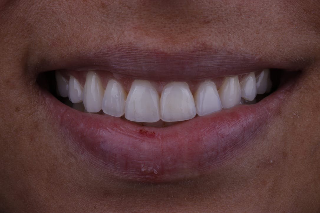 Bonding Before & After Photos Islay Hill Dentistry Co.