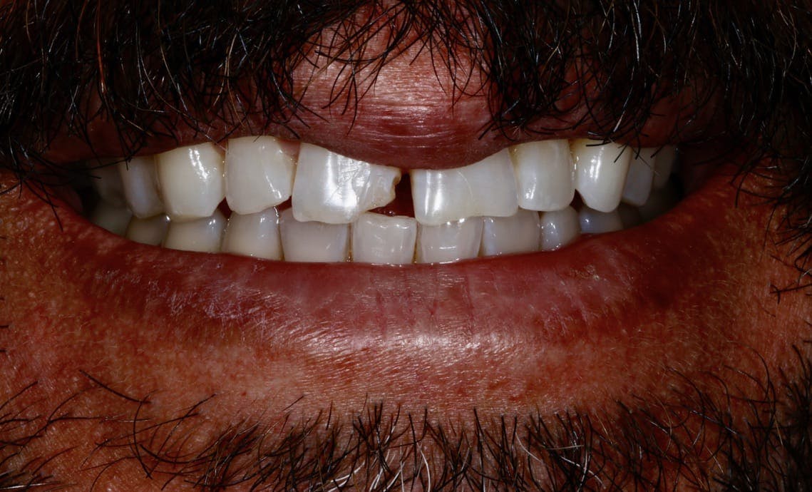 Bonding Before & After Photos Islay Hill Dentistry Co.