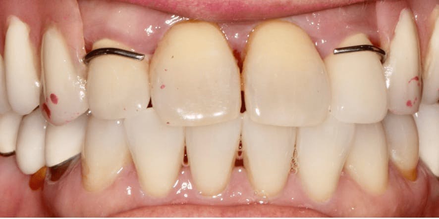 Fixed Hybrid Dentures Before & After Gallery - Patient 55475039 - Image 1