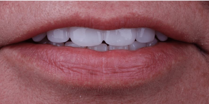Fixed Hybrid Dentures Before & After Gallery - Patient 55475039 - Image 2