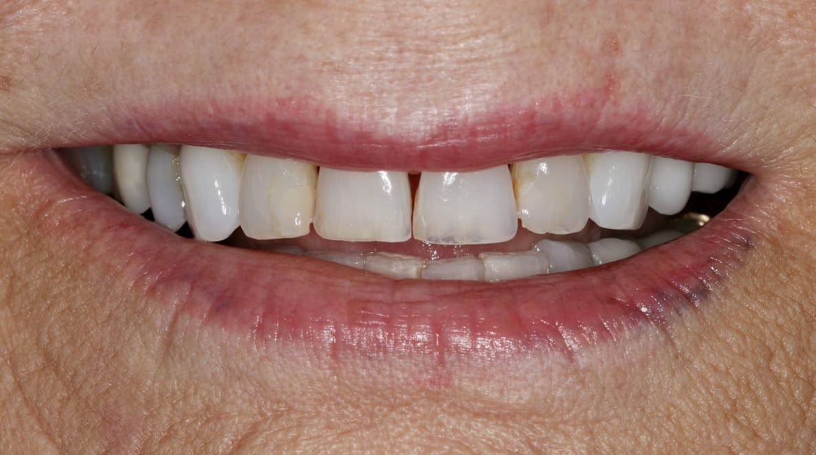 Anti-Aging Dentistry Before & After Gallery - Patient 55475040 - Image 3