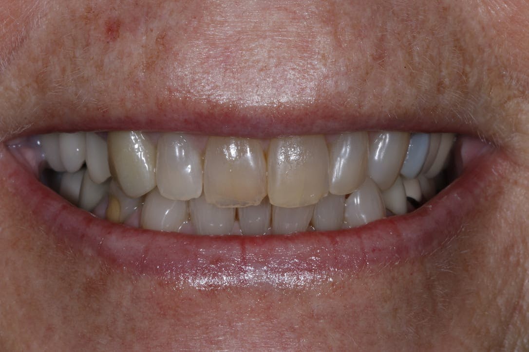 AntiAging Dentistry Before & After Photos Islay Hill Dentistry Co.