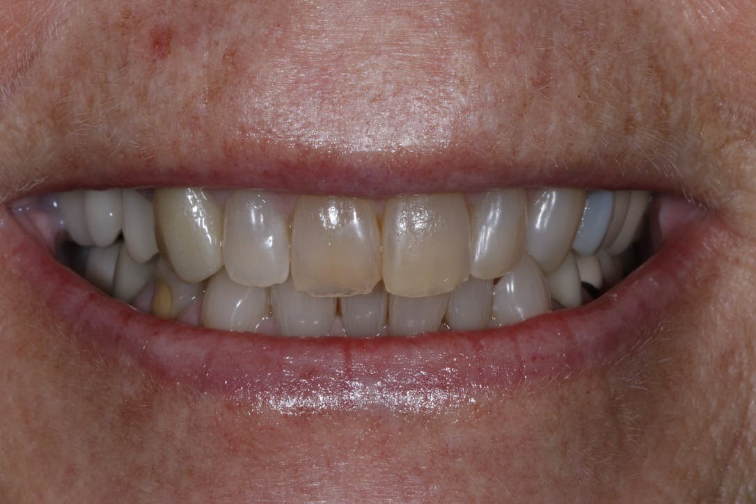 Anti-Aging Dentistry Before & After Gallery - Patient 55475041 - Image 1