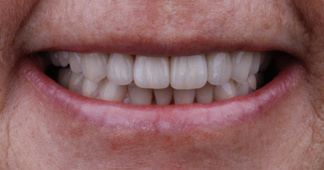 Anti-Aging Dentistry Before & After Gallery - Patient 55475041 - Image 2