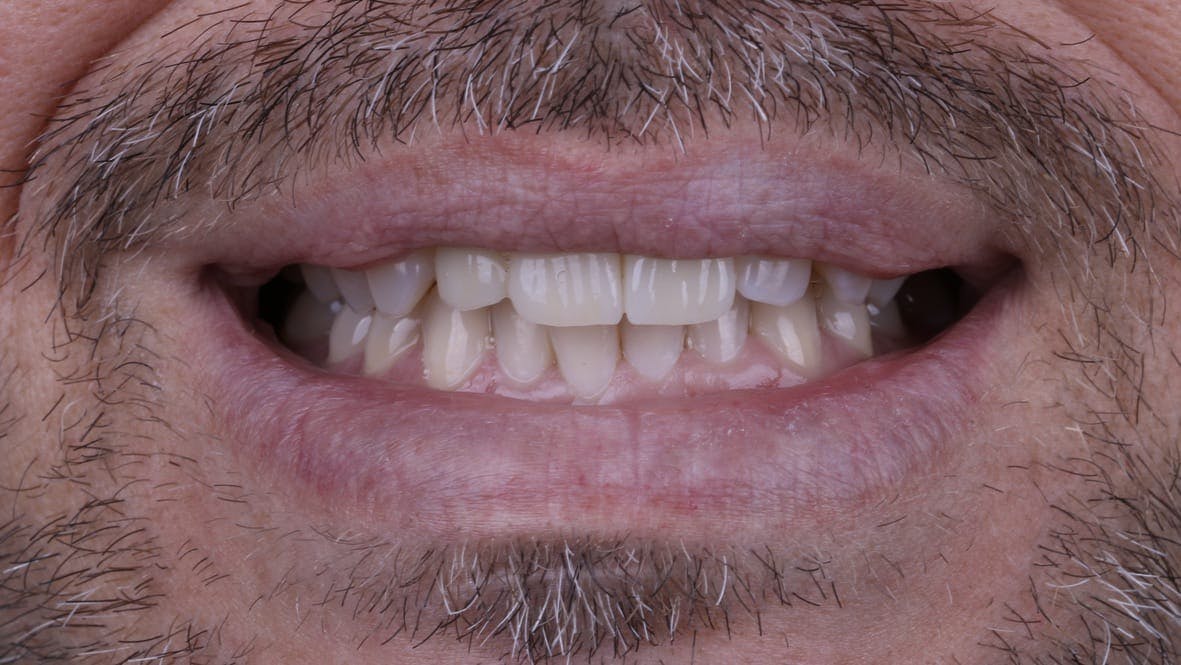 Implant Bridge Before & After Photos Islay Hill Dentistry Co.