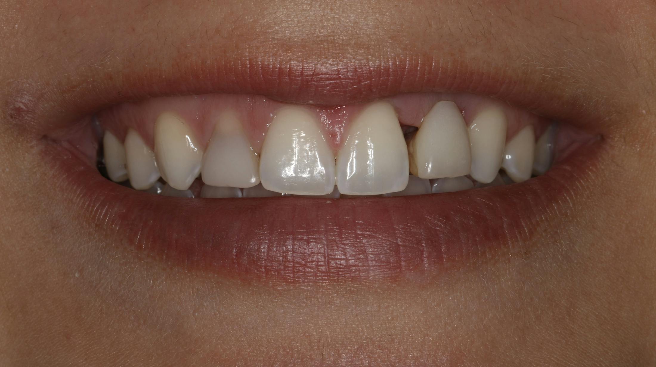 Implant Crown Before & After Gallery - Patient 55475044 - Image 1