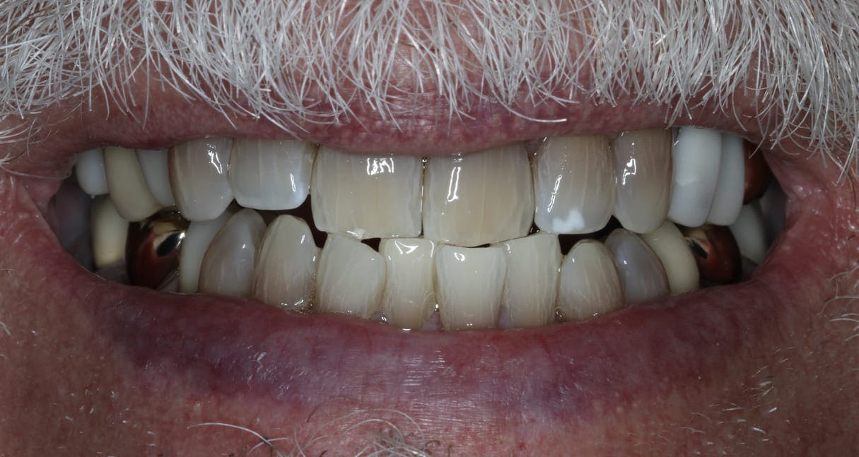 KOR Teeth Whitening Before & After Photos Islay Hill Dentistry Co.