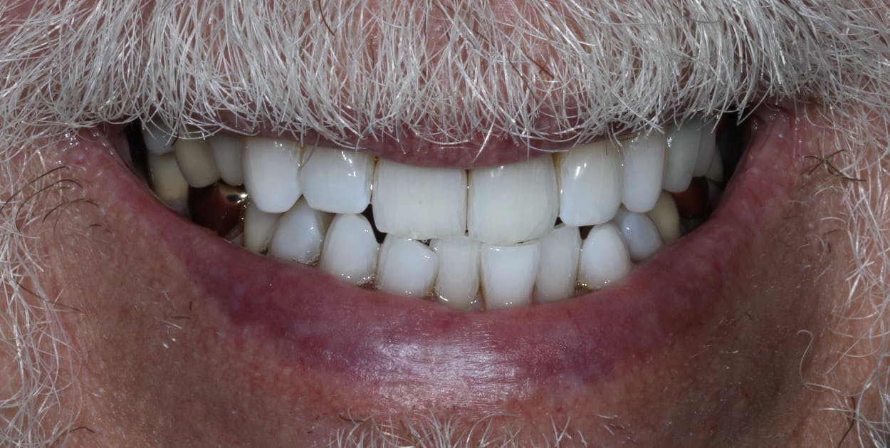 KOR Teeth Whitening Before & After Gallery - Patient 55475045 - Image 2