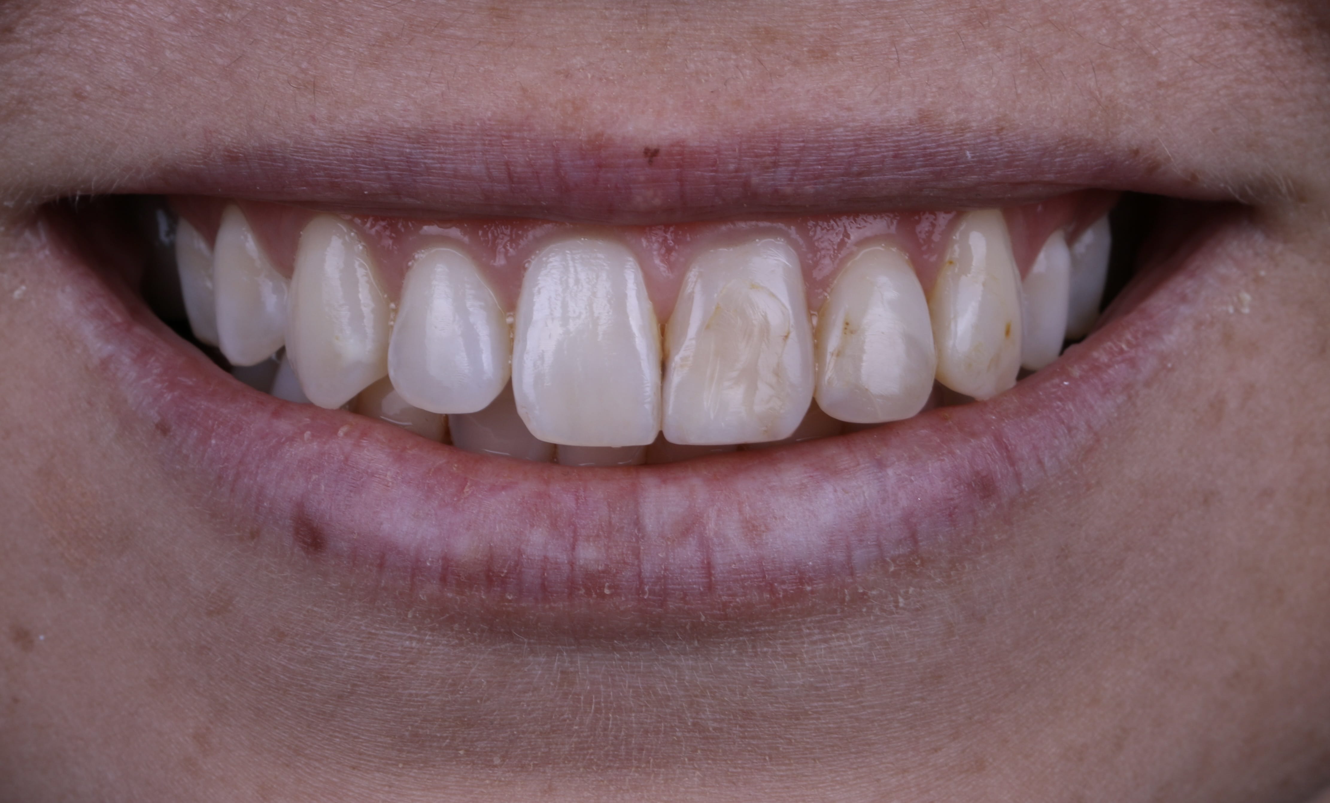 Porcelain Veneers San Luis Obispo Porcelain Veneers in Arroyo Grande
